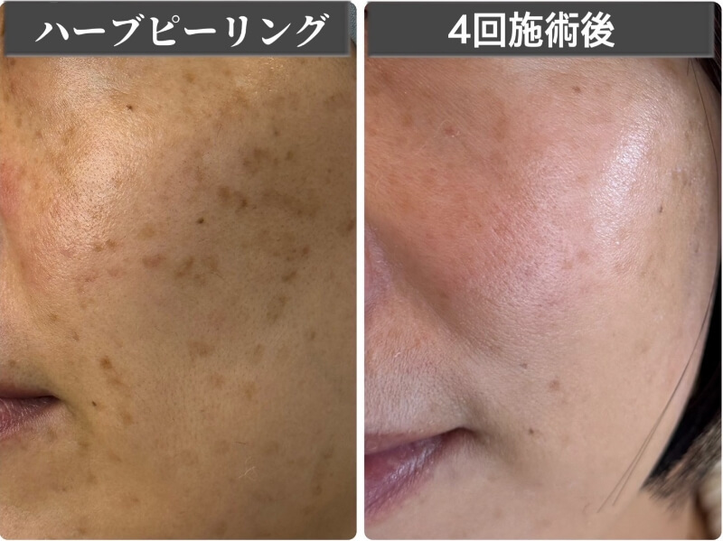 ビフォーアフター(シミケア)