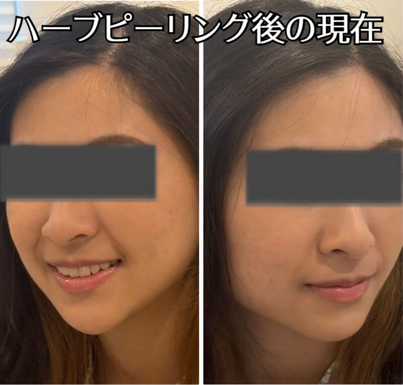 ビフォーアフター(美肌ケアの場合)